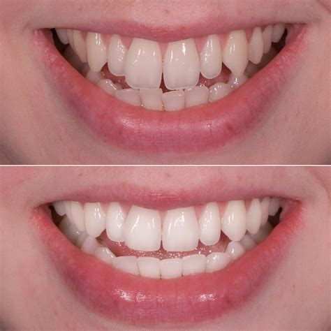 tooth contouring before and after.